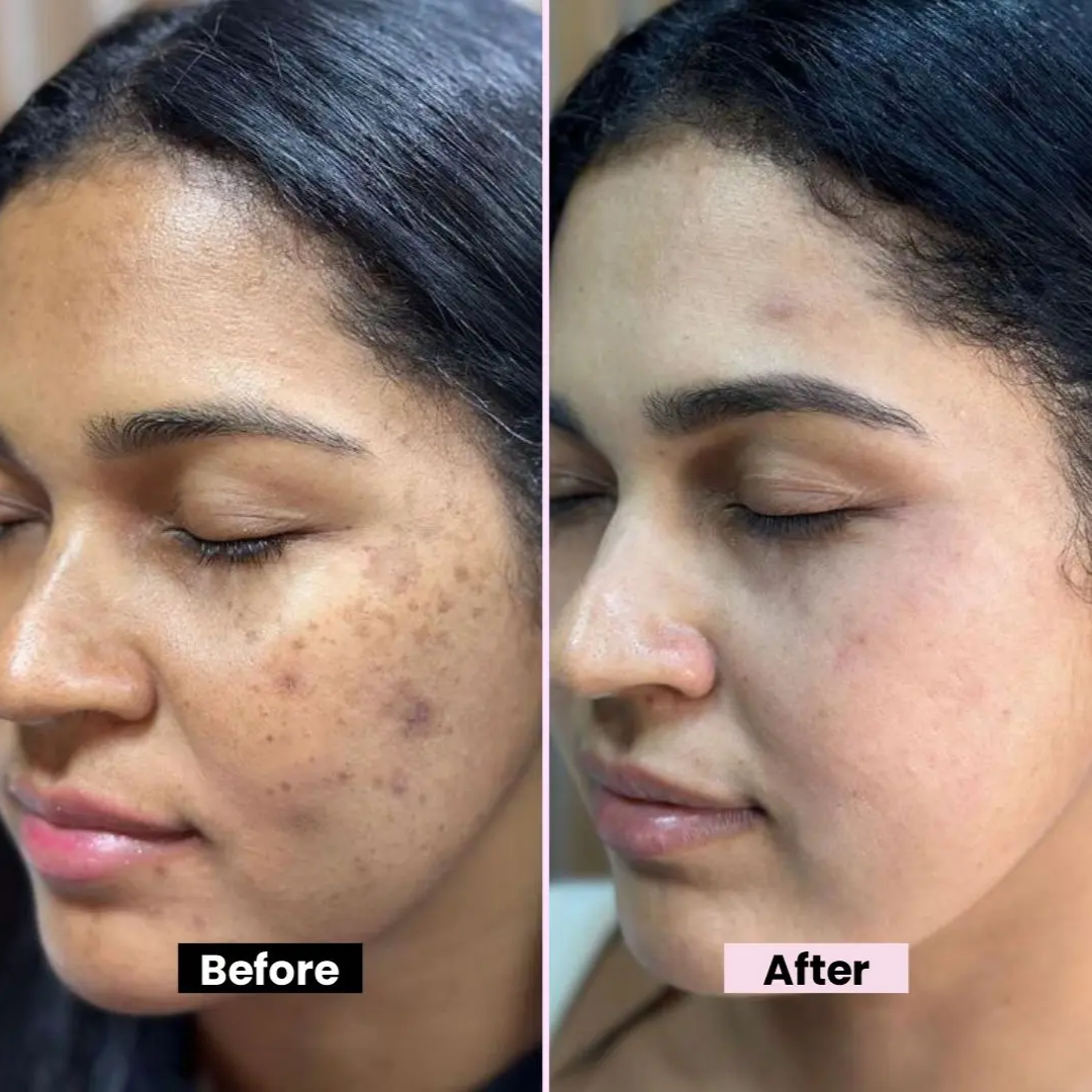 Buy 1 Get 1 Free - Chalonese Brightening Cream