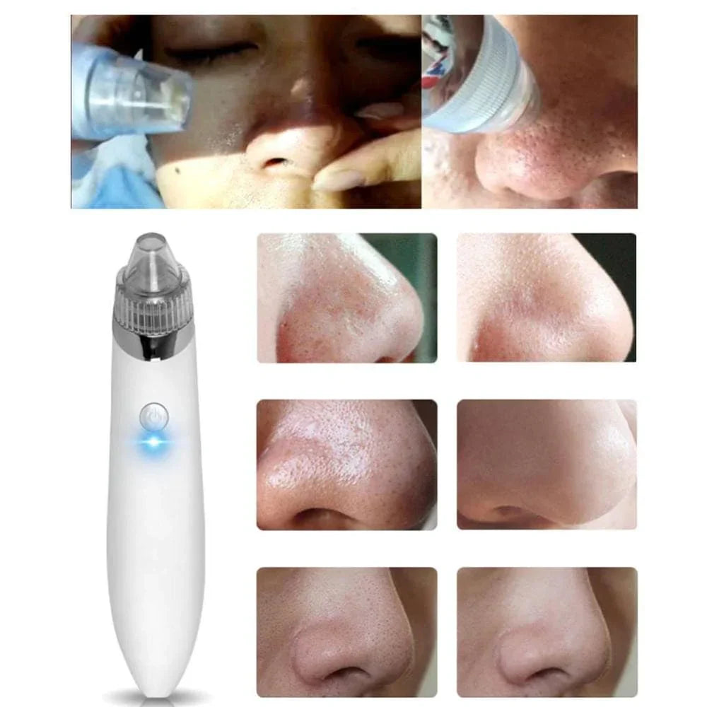 The Epic®Pore Cleaner (Remove Oil/Dirt/Blackheads)